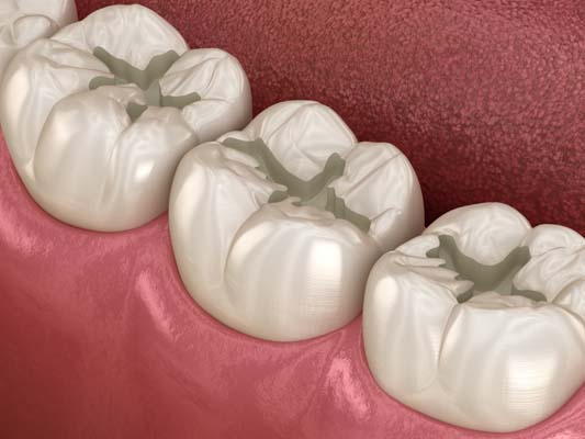 Benefits Of Dental Fillings