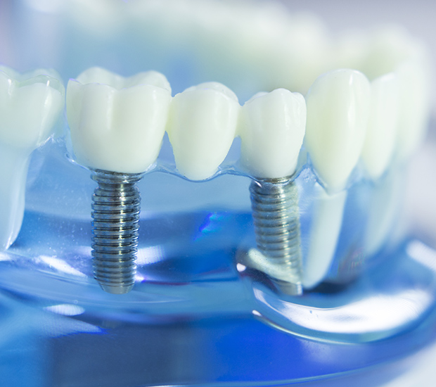 Patterson Dental Implants