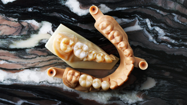 Care Tips For Implant Supported Dentures